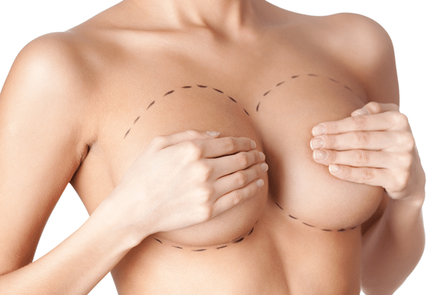 Mastoplastica additiva - Ingrandimento del seno