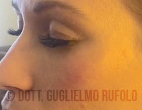 Lifting - Chirurgia Plastica del Viso - Dott. Guglielmo Rufolo