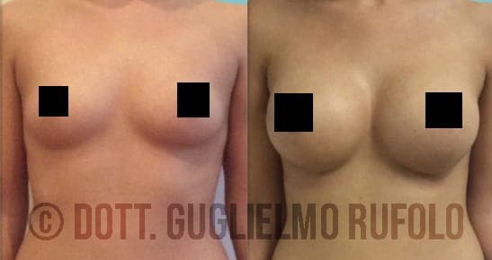Mastoplastica Additiva - Chirurgo Plastico Dott. Guglielmo Rufolo