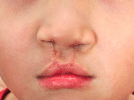 chirurgia cranio-facciale pediatrica - labbro leporino
