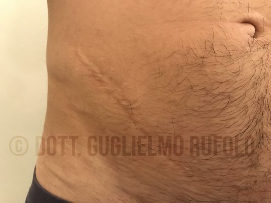 Cicatrici trattamento con Chirurgo Plastico - Dott. Guglielmo Rufolo
