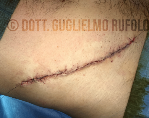 Cicatrici trattamento con Chirurgo Plastico - Dott. Guglielmo Rufolo